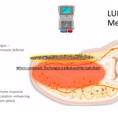 Lunula Laser Webinar