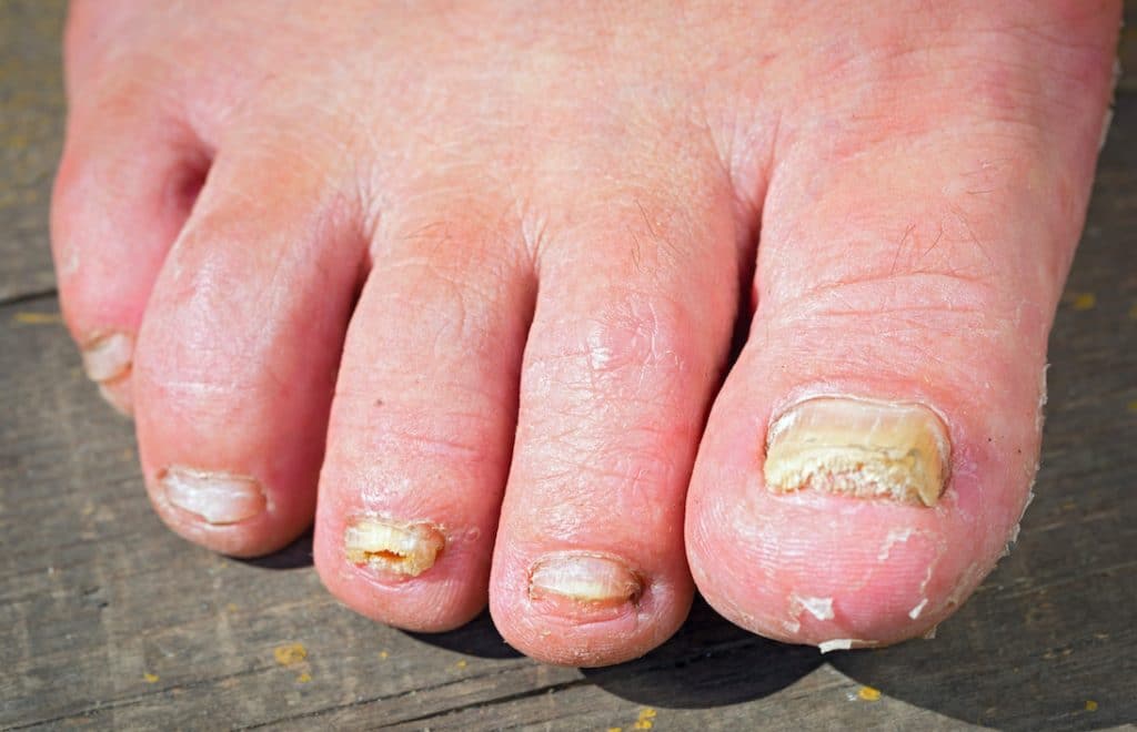 4 Signs You Have A Fungal Nail Infection – And How To Stop It