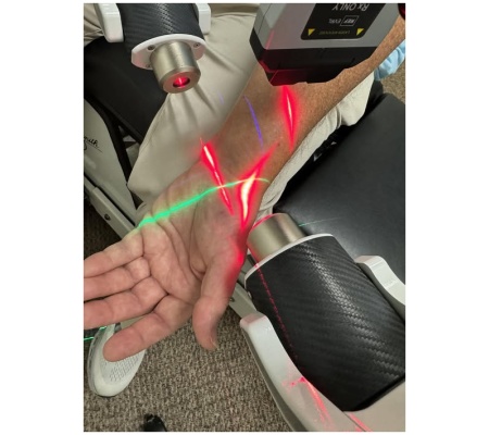 FX405 Treatment